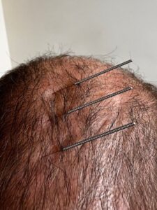 AcuMeD Acupuncture & Herbs